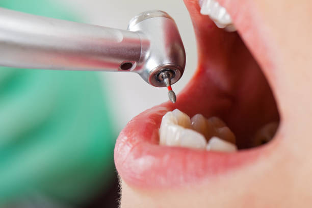 Best Emergency Wisdom Teeth Removal in Wakefield, VA